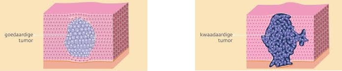 Goedaardige tumor en kwaadaardige tumor