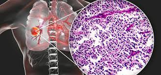 Hyperthermie longkanker