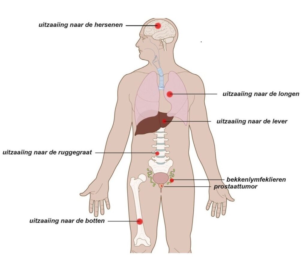 Uitgezaaide prostaattumor