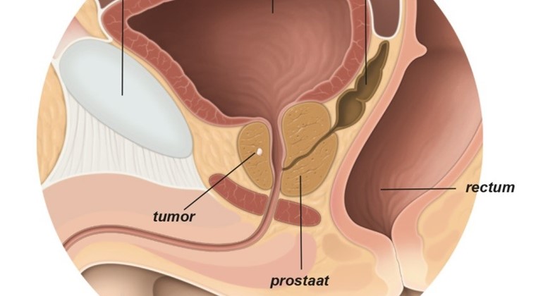 Prostaatkanker
